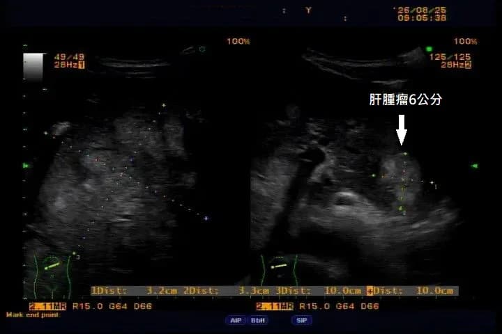 肝腫瘤